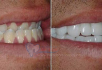 RĂNG BỊ MÓM CÓ BỌC SỨ ĐƯỢC KHÔNG? RĂNG BỊ MÓM CÓ BỌC SỨ ĐƯỢC KHÔNG?