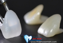 SO SÁNH ƯU NHƯỢC ĐIỂM GIỮA RĂNG SỨ ZIRCONIA VÀ CERCON SO SÁNH ƯU NHƯỢC ĐIỂM GIỮA RĂNG SỨ ZIRCONIA VÀ CERCON