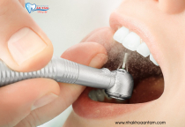 BỌC RĂNG SỨ KHÔNG MÀI RĂNG ĐƯỢC KHÔNG? BỌC RĂNG SỨ KHÔNG MÀI RĂNG ĐƯỢC KHÔNG?