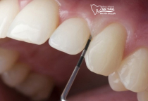 NHA KHOA BẢO TỒN - KHI NÀO CẦN MÀI RĂNG NGẮN LẠI? NHA KHOA BẢO TỒN - KHI NÀO CẦN MÀI RĂNG NGẮN LẠI?
