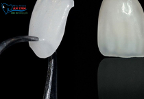 NHA KHOA BẢO TỒN - TUỔI THỌ CỦA MẶT DÁN SỨ VENEER LÀ BAO LÂU? NHA KHOA BẢO TỒN - TUỔI THỌ CỦA MẶT DÁN SỨ VENEER LÀ BAO LÂU?