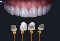 DÁN SỨ VENEER CÓ GÂY HÔI MIỆNG KHÔNG? DÁN SỨ VENEER CÓ GÂY HÔI MIỆNG KHÔNG?