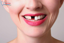 MẤT RĂNG BAO LÂU THÌ BỊ TIÊU XƯƠNG HÀM. MẤT RĂNG BAO LÂU THÌ BỊ TIÊU XƯƠNG HÀM.