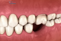 GÃY RĂNG HÀM CÓ ẢNH HƯỞNG GÌ KHÔNG? GÃY RĂNG HÀM CÓ ẢNH HƯỞNG GÌ KHÔNG?