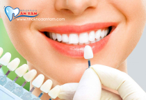 04 MÀU VENEER PHỔ BIẾN & CHỌN MÀU RĂNG CHO VENEER SỨ 04 MÀU VENEER PHỔ BIẾN & CHỌN MÀU RĂNG CHO VENEER SỨ