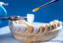 DÁN SỨ VENEER CÓ TỐT CHO RĂNG KHÔNG? DÁN SỨ VENEER CÓ TỐT CHO RĂNG KHÔNG?