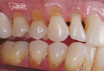 NHA KHOA BẢO TỒN - MÒN CỔ CHÂN RĂNG: NGUYÊN NHÂN VÀ CÁCH PHÒNG NGỪA NHA KHOA BẢO TỒN - MÒN CỔ CHÂN RĂNG: NGUYÊN NHÂN VÀ CÁCH PHÒNG NGỪA