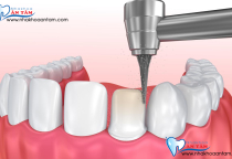 NHA KHOA BẢO TỒN - KỸ THUẬT MÀI RĂNG THẾ NÀO ĐÚNG CHUẨN? NHA KHOA BẢO TỒN - KỸ THUẬT MÀI RĂNG THẾ NÀO ĐÚNG CHUẨN?
