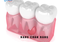 NANG CHÂN RĂNG LÀ GÌ? CÓ NGUY HIỂM KHÔNG? NANG CHÂN RĂNG LÀ GÌ? CÓ NGUY HIỂM KHÔNG?