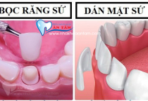 SỰ KHÁC BIỆT GIỮA DÁN SỨ VENEER VÀ BỌC RĂNG SỨ SỰ KHÁC BIỆT GIỮA DÁN SỨ VENEER VÀ BỌC RĂNG SỨ