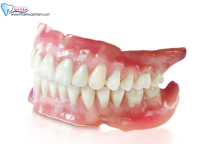 RĂNG SỨ THÁO LẮP – PHỤC HÌNH MẤT NHIỀU RĂNG RĂNG SỨ THÁO LẮP – PHỤC HÌNH MẤT NHIỀU RĂNG
