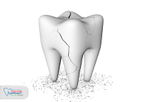 NHA KHOA BẢO TỒN - BỊ MẺ RĂNG HÀM CÓ SAO KHÔNG? NHA KHOA BẢO TỒN - BỊ MẺ RĂNG HÀM CÓ SAO KHÔNG?