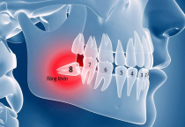NHA KHOA BẢO TỒN - RĂNG KHÔN LÀ GÌ ??? NHA KHOA BẢO TỒN - RĂNG KHÔN LÀ GÌ ???