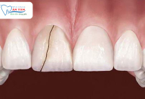 NHA KHOA BẢO TỒN - RĂNG BỊ NỨT CÓ TỰ LÀNH ĐƯỢC KHÔNG? NHA KHOA BẢO TỒN - RĂNG BỊ NỨT CÓ TỰ LÀNH ĐƯỢC KHÔNG?