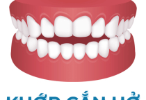 NHA KHOA BẢO TỒN - KHỚP CẮN HỞ LÀ GÌ? CÁCH ĐIỀU TRỊ KHỚP CẮN HỞ NHA KHOA BẢO TỒN - KHỚP CẮN HỞ LÀ GÌ? CÁCH ĐIỀU TRỊ KHỚP CẮN HỞ