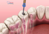 CÁC TRIỆU CHỨNG SAU KHI LẤY TỦY RĂNG CÁC TRIỆU CHỨNG SAU KHI LẤY TỦY RĂNG