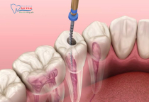 NHA KHOA BẢO TỒN - TUỔI THỌ RĂNG LẤY TỦY KÉO DÀI BAO LÂU? NHA KHOA BẢO TỒN - TUỔI THỌ RĂNG LẤY TỦY KÉO DÀI BAO LÂU?