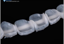 NHỮNG TRƯỜNG HỢP NÊN DÁN VENEER NHỮNG TRƯỜNG HỢP NÊN DÁN VENEER