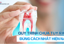 QUY TRÌNH ĐIỀU TRỊ TỦY RĂNG ĐÚNG CHUẨN NHẤT HIỆN NAY. QUY TRÌNH ĐIỀU TRỊ TỦY RĂNG ĐÚNG CHUẨN NHẤT HIỆN NAY.