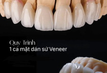 NHA KHOA BẢO TỒN - QUY TRÌNH DÁN SỨ VENEER ĐÚNG CHUẨN NHA KHOA BẢO TỒN - QUY TRÌNH DÁN SỨ VENEER ĐÚNG CHUẨN