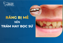 RĂNG MẺ NÊN TRÁM HAY BỌC SỨ? RĂNG MẺ NÊN TRÁM HAY BỌC SỨ?