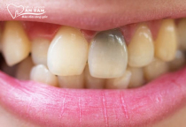 NHA KHOA BẢO TỒN - DẤU HIỆU RĂNG BỊ CHẾT TỦY VÀ CÁCH ĐIỀU TRỊ HIỆU QUẢ NHA KHOA BẢO TỒN - DẤU HIỆU RĂNG BỊ CHẾT TỦY VÀ CÁCH ĐIỀU TRỊ HIỆU QUẢ