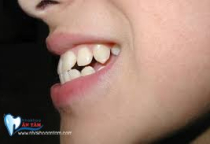RĂNG HÔ LÀ GÌ?CÁCH KHẮC PHỤC NHƯ THẾ NÀO? RĂNG HÔ LÀ GÌ?CÁCH KHẮC PHỤC NHƯ THẾ NÀO?