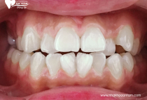 LÀM GÌ VỚI RĂNG KHẤP KHỂNH LÀM GÌ VỚI RĂNG KHẤP KHỂNH