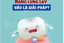 RĂNG LUNG LAY NGUYÊN NHÂN DO ĐÂU? RĂNG LUNG LAY NGUYÊN NHÂN DO ĐÂU?
