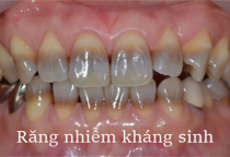 NHA KHOA BẢO TỒN - NGUYÊN NHÂN VÀ CÁCH KHẮC PHỤC RĂNG NHIỄM KHÁNG SINH NHA KHOA BẢO TỒN - NGUYÊN NHÂN VÀ CÁCH KHẮC PHỤC RĂNG NHIỄM KHÁNG SINH