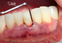 PHẢI LÀM GÌ KHI RĂNG SÂU CHẢY MÁU? PHẢI LÀM GÌ KHI RĂNG SÂU CHẢY MÁU?