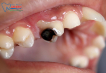 NHA KHOA BẢO TỒN - ĐAU RĂNG SÂU NÊN LÀM GÌ? NHA KHOA BẢO TỒN - ĐAU RĂNG SÂU NÊN LÀM GÌ?
