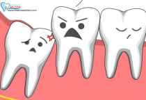 NHẬN DIỆN CÁC KIỂU RĂNG KHÔN MỌC PHỔ BIẾN NHẬN DIỆN CÁC KIỂU RĂNG KHÔN MỌC PHỔ BIẾN
