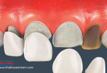NGUYÊN NHÂN VÀ CÁCH KHẮC PHỤC RĂNG SỨ BỊ RỚT  NGUYÊN NHÂN VÀ CÁCH KHẮC PHỤC RĂNG SỨ BỊ RỚT