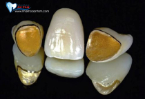 RĂNG SỨ KIM LOẠI LÀ GÌ ? ƯU VÀ NHƯƠC ĐIỂM CÁC LOẠI RĂNG SỨ KIM LOẠI? RĂNG SỨ KIM LOẠI LÀ GÌ ? ƯU VÀ NHƯƠC ĐIỂM CÁC LOẠI RĂNG SỨ KIM LOẠI?