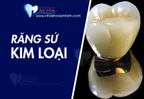 RĂNG SỨ KIM LOẠI CÓ TỐT KHÔNG? RĂNG SỨ KIM LOẠI CÓ TỐT KHÔNG?