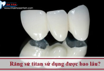 RĂNG SỨ TITAN SỬ DỤNG ĐƯỢC BAO LÂU RĂNG SỨ TITAN SỬ DỤNG ĐƯỢC BAO LÂU
