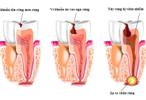 NHA KHOA BẢO TỒN - QUÁ TRÌNH SÂU RĂNG NHA KHOA BẢO TỒN - QUÁ TRÌNH SÂU RĂNG