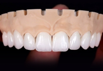 RĂNG SỨ THẨM MỸ