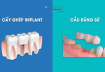 CẦU RĂNG SỨ VÀ IMPLANT PHƯƠNG PHÁP NÀO TỐT HƠN? CẦU RĂNG SỨ VÀ IMPLANT PHƯƠNG PHÁP NÀO TỐT HƠN?