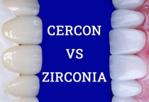 ƯU NHƯỢC ĐIỂM GIỮA RĂNG SỨ ZIRCONIA VÀ CERCON ƯU NHƯỢC ĐIỂM GIỮA RĂNG SỨ ZIRCONIA VÀ CERCON