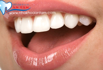 RĂNG SỨ CERAMILL CÓ MẤY LOẠI? RĂNG SỨ CERAMILL CÓ MẤY LOẠI?