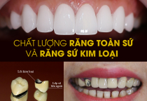 ƯU ĐIỂM NỔI BẬT RĂNG SỨ TOÀN SỨ TẠI NHA KHOA ÂN TÂM ƯU ĐIỂM NỔI BẬT RĂNG SỨ TOÀN SỨ TẠI NHA KHOA ÂN TÂM