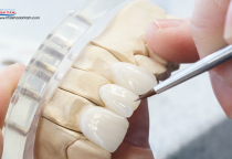 CÁC DÒNG RĂNG SỨ ĐỨC PHỔ BIẾN TẠI VIỆT NAM. CÁC DÒNG RĂNG SỨ ĐỨC PHỔ BIẾN TẠI VIỆT NAM.