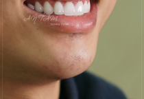 TÁC HẠI CỦA RĂNG SỨ KIM LOẠI TÁC HẠI CỦA RĂNG SỨ KIM LOẠI