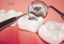 NHA KHOA BẢO TỒN - KHI NÀO CẦN TRÁM RĂNG? NHA KHOA BẢO TỒN - KHI NÀO CẦN TRÁM RĂNG?