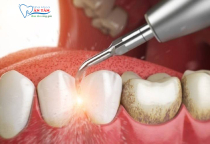 NHA KHOA BẢO TỒN - TÁC HẠI KHI LẤY CAO RĂNG SAI CÁCH