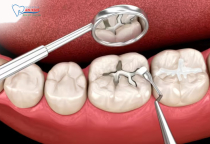 NHA KHOA BẢO TỒN - TÁC HẠI  CỦA VIỆC TRÁM RĂNG SAI KỸ THUẬT NHA KHOA BẢO TỒN - TÁC HẠI  CỦA VIỆC TRÁM RĂNG SAI KỸ THUẬT
