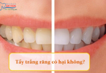 NHA KHOA BẢO TỒN - TẨY TRẮNG RĂNG CÓ HẠI KHÔNG? NHA KHOA BẢO TỒN - TẨY TRẮNG RĂNG CÓ HẠI KHÔNG?