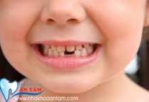 TRẺ EM CÓ ĐƯỢC BỌC RĂNG SỨ KHÔNG? TRẺ EM CÓ ĐƯỢC BỌC RĂNG SỨ KHÔNG?